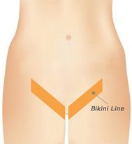 laser hair removal bikini line