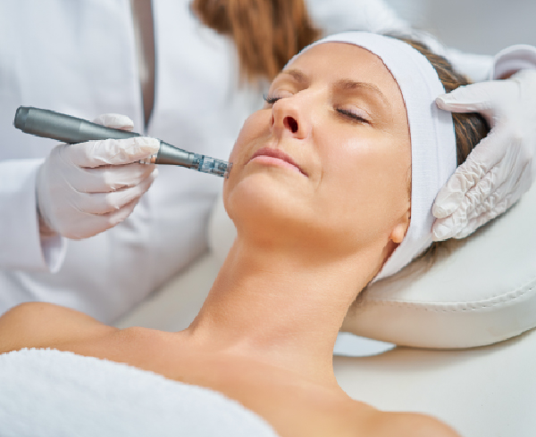 microneedling