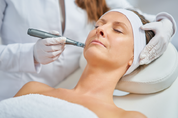 microneedling